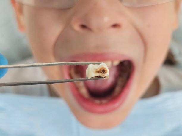 Best Broken or Chipped Tooth Repair in Greensboro, AL